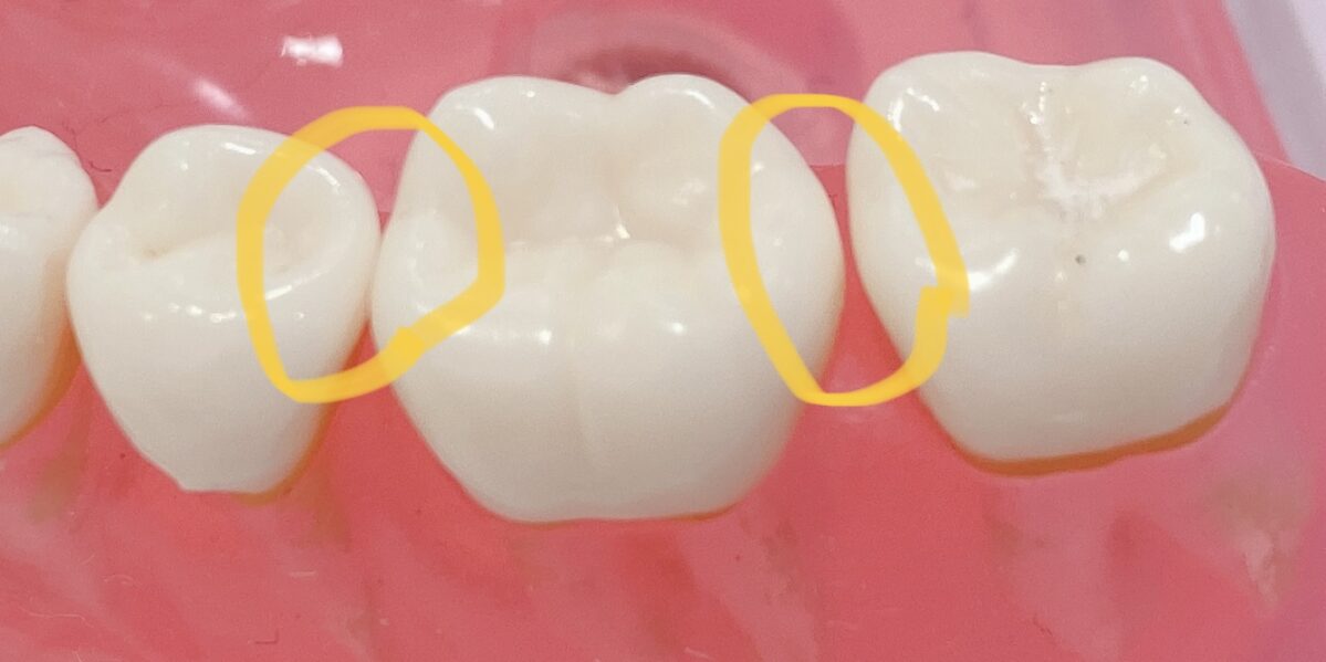 歯列模型で歯と歯の間を黄色い丸で示した図
