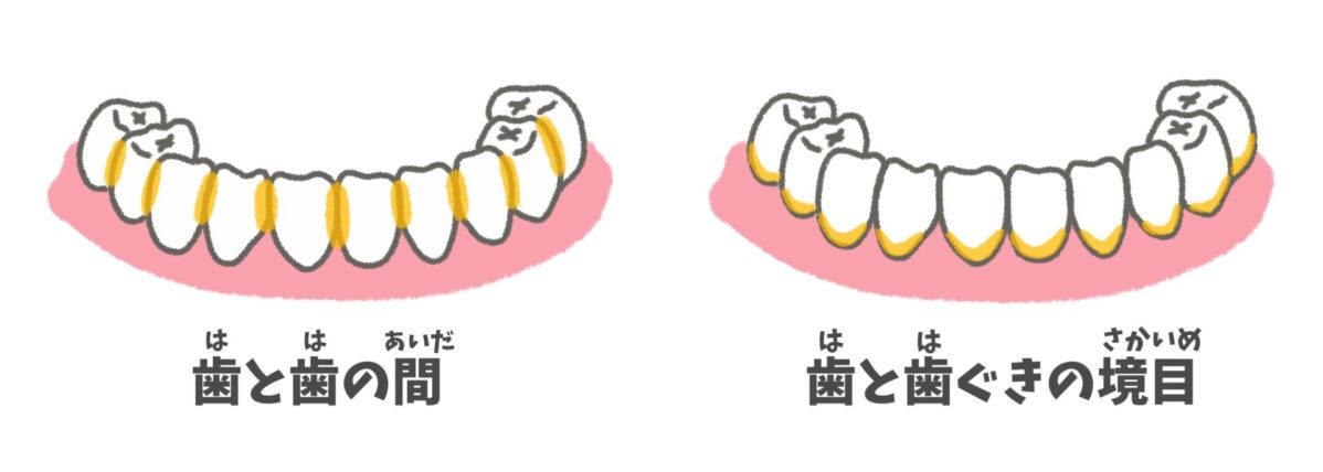 歯と歯の間、歯と歯ぐきの境目の磨き残しやすい場所を色で示した図