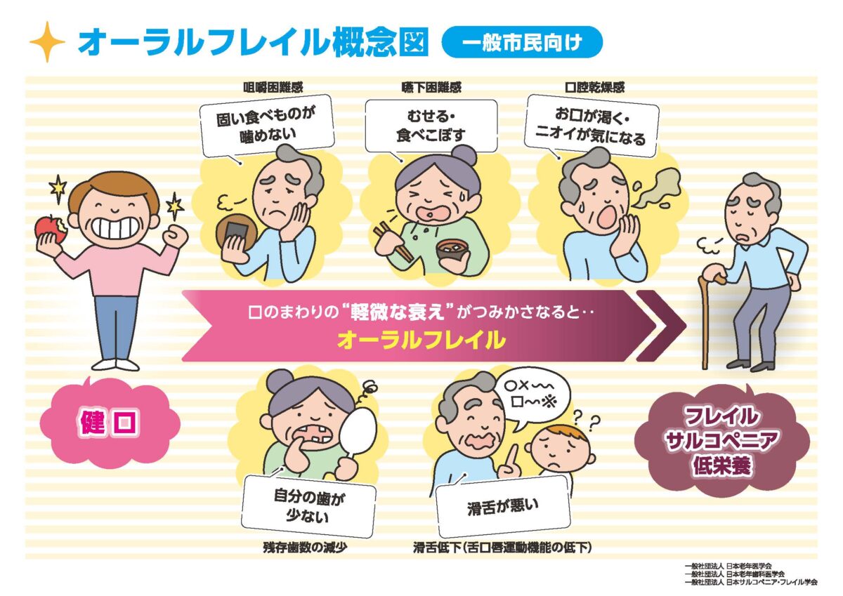 噛みにくさ、むせ、口の乾燥、歯の減少、滑舌の低下を示す一般市民向けオーラルフレイル概念図
