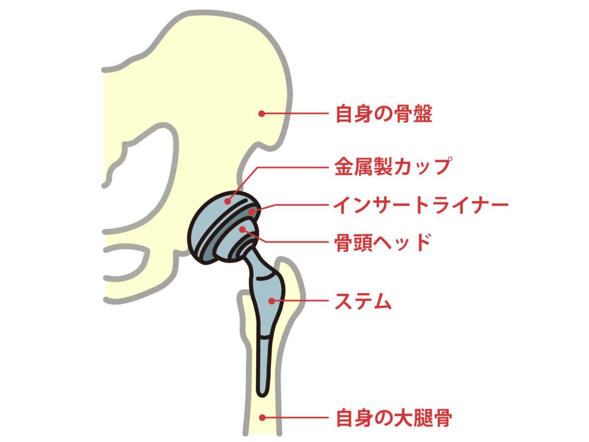 骨盤と大腿骨に設置された人工股関節の金属製カップ、インサートライナー、骨頭ヘッド、ステムを示す模式図