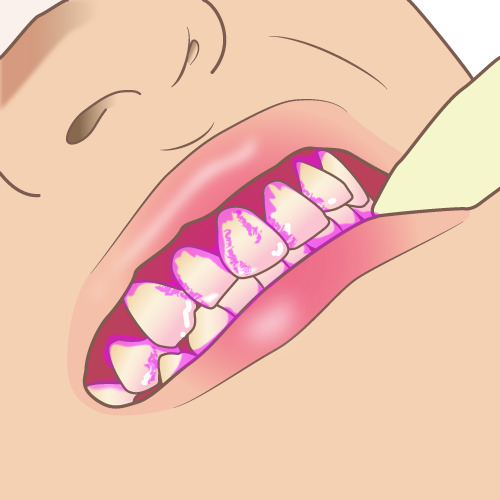 染め出し液で歯に付いたプラークを確認するイラスト