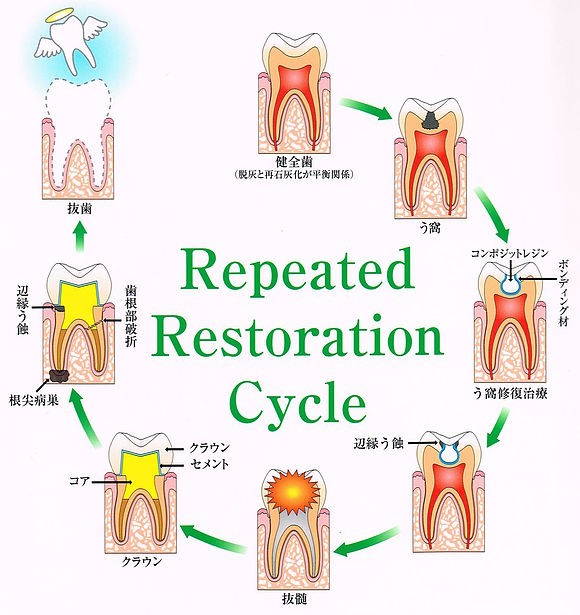図1 「Repeated Restoration Cycle」と題した日本語の図。健全歯からう窩、コンポジットレジン修復、辺縁う蝕、抜髄、クラウンを経て、歯根破折や根尖病巣から抜歯に至る流れを円で描いている
