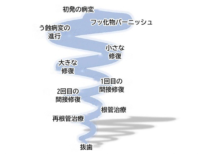 図3の和訳。初発の病変、フッ化物バーニッシュ、う蝕病変の進行、小さな修復、大きな修復、1回目と2回目の間接修復、根管治療、再根管治療を経て抜歯に至るらせん