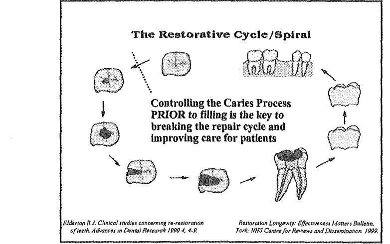 図4 英国Pittsのスライド「The Restorative Cycle/Spiral」。小さなう蝕から詰め物、大きな詰め物、根管治療、被せ物を経て、歯の抜けた歯列に至る歯の絵を円に並べ、下にElderton 1990とNHSの資料を出典として記している