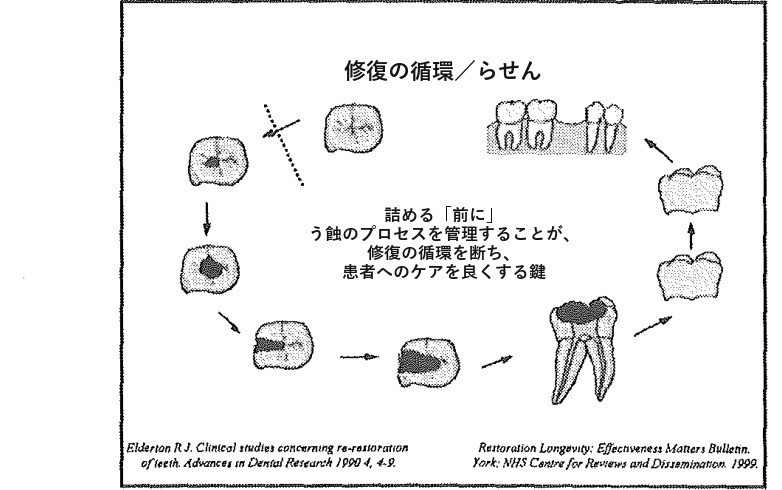 図4の和訳。題は「修復の循環/らせん」。中央に「詰める「前に」う蝕のプロセスを管理することが、修復の循環を断ち、患者へのケアを良くする鍵」とあり、歯の絵が円に並ぶ