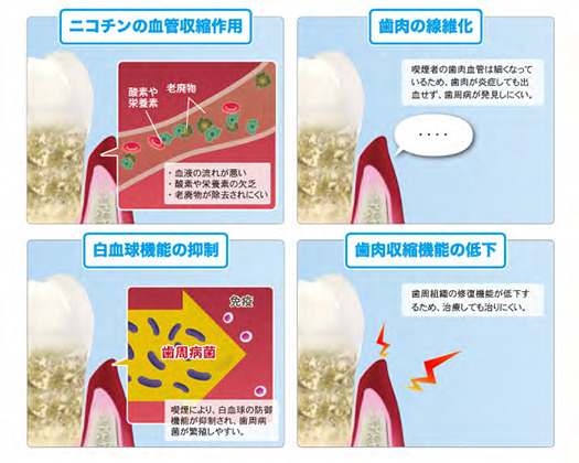 喫煙が歯周組織へ及ぼす作用を示す図。血管収縮、歯肉の線維化、白血球機能と歯肉収縮能の低下