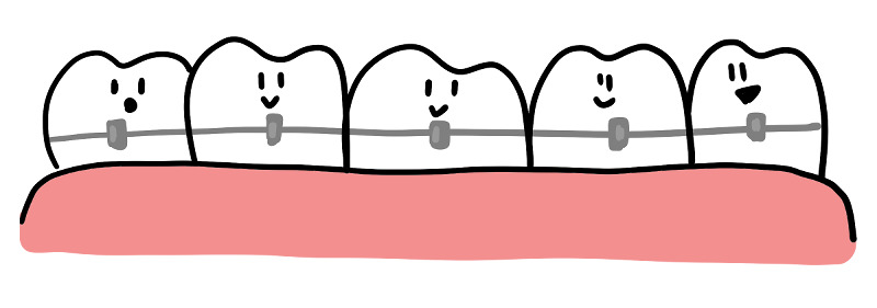 ブラケットとワイヤーを装着した歯のイラスト