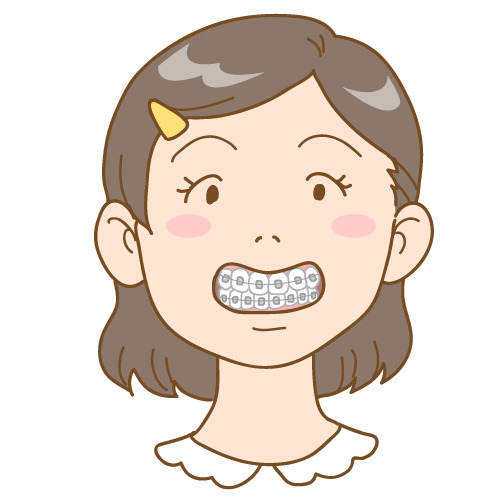 歯にワイヤー矯正装置を付けて笑う女性のイラスト
