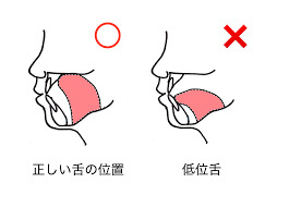 舌が上あごにつく位置と低い位置にある状態を比較した図