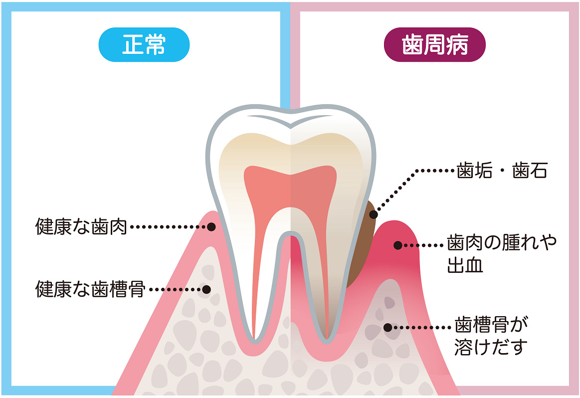 健康な歯周組織と歯周病による歯ぐき・骨の変化を比較する図