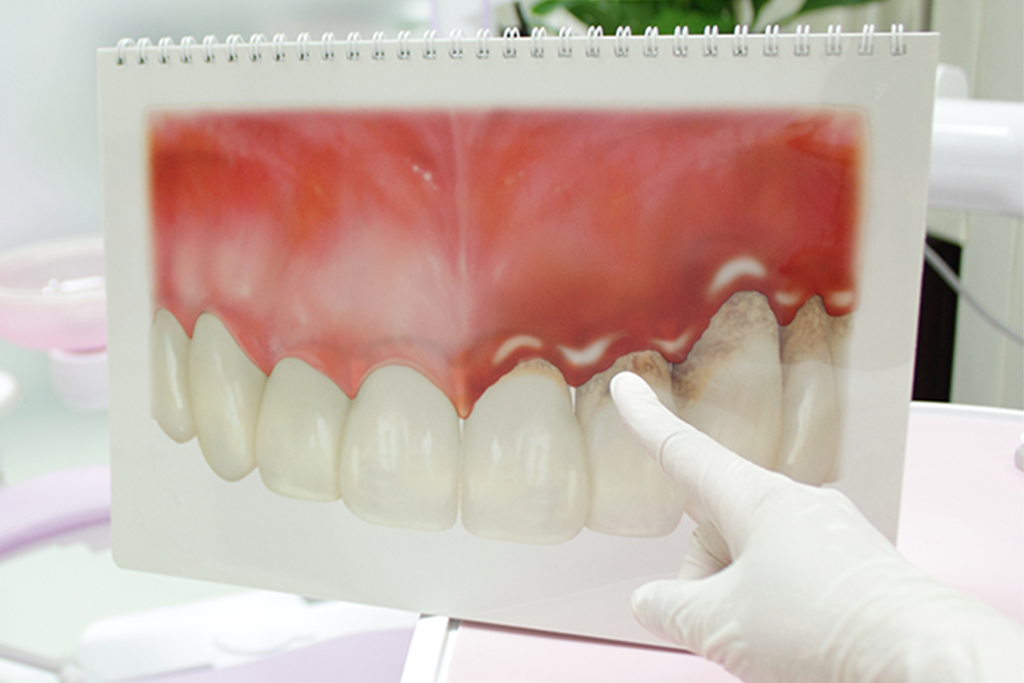 軽度から重度まで、歯周病の進行段階に合わせて対応