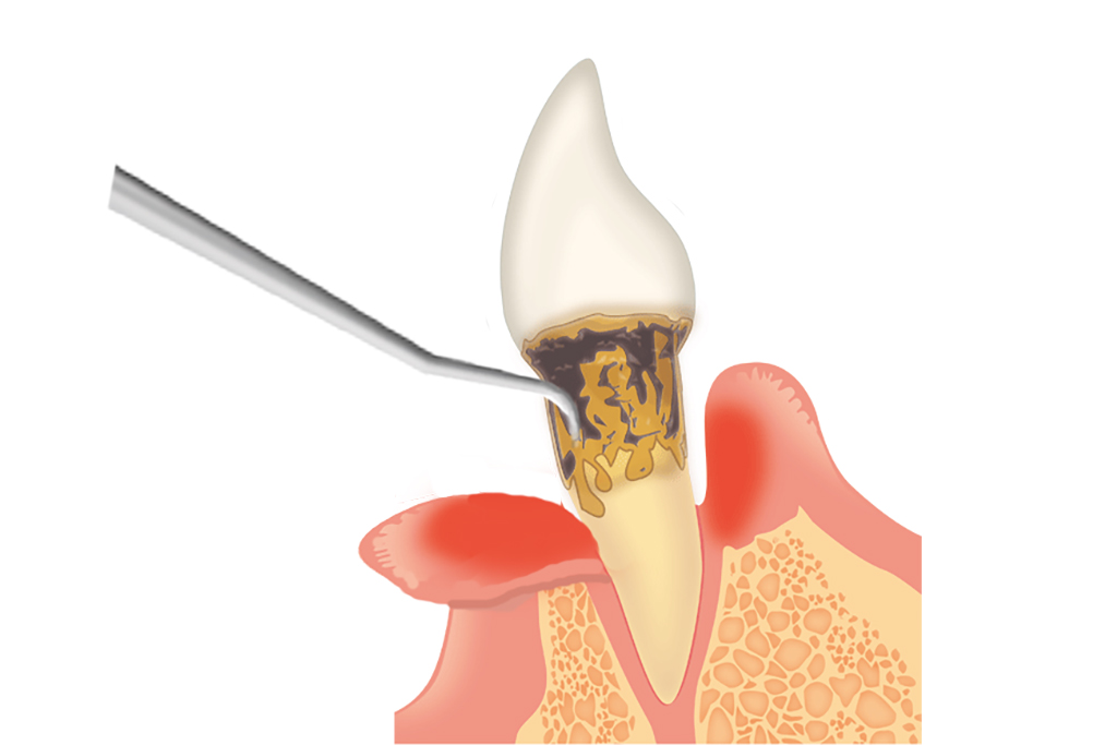 歯根についた歯石を取り除く　歯周病外科治療「フラップ手術」